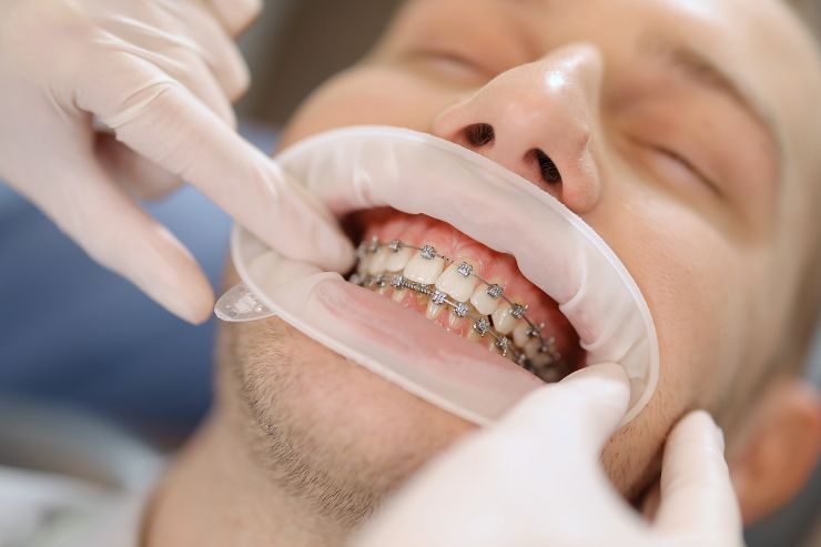 Orthodontic Treatment